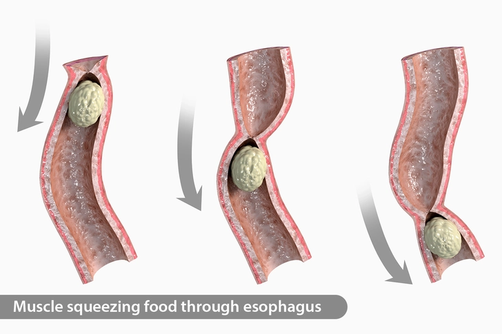 Esophageal Spasm Esophageal Spasm