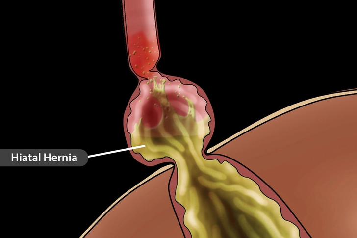 Hiatal Hernia