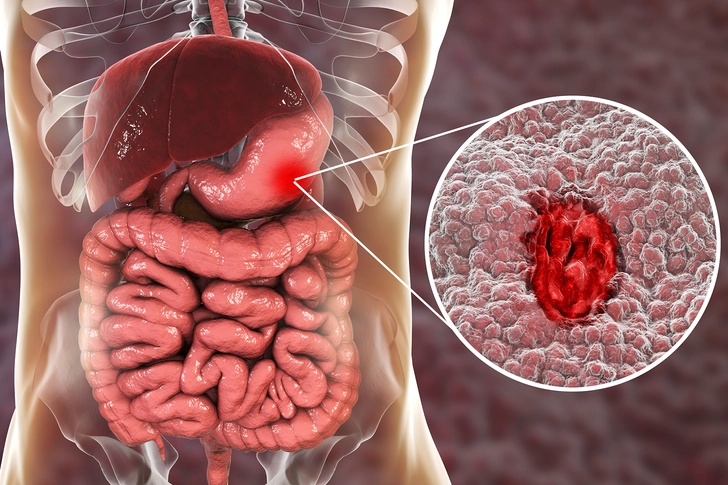 Stomach Ulcer