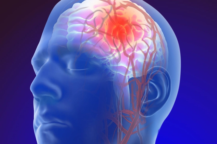 Recovering From a Stroke Recovering From a Stroke