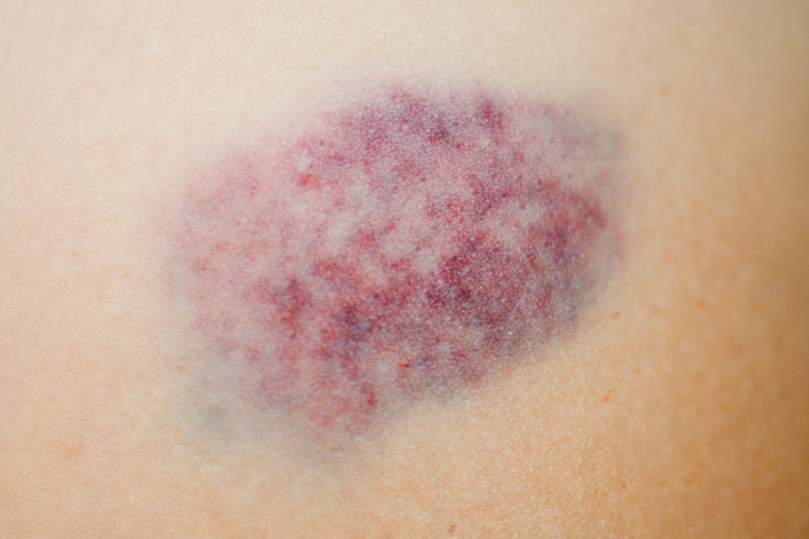 Easy Bruising Easy Bruising