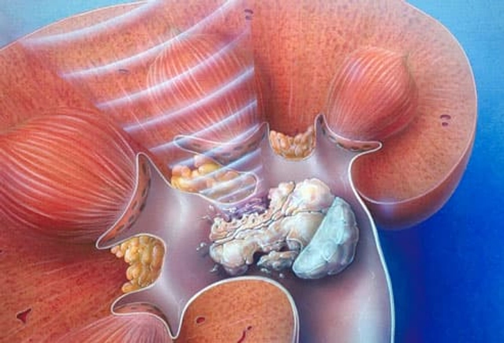 Treatment: Shock Wave Therapy
