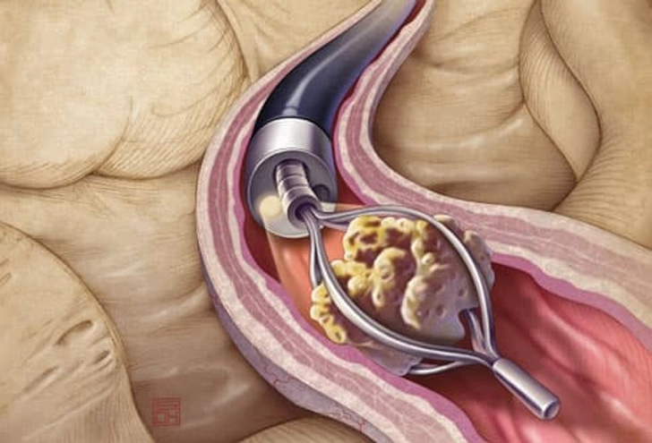 Treatment: Ureteroscopy