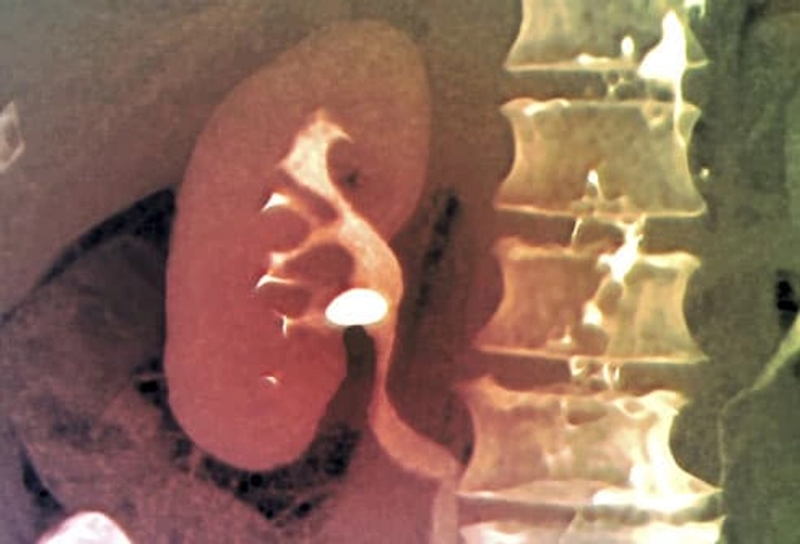 Diagnosing Kidney Stones
