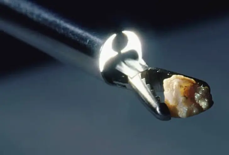 What Are Kidney Stones?