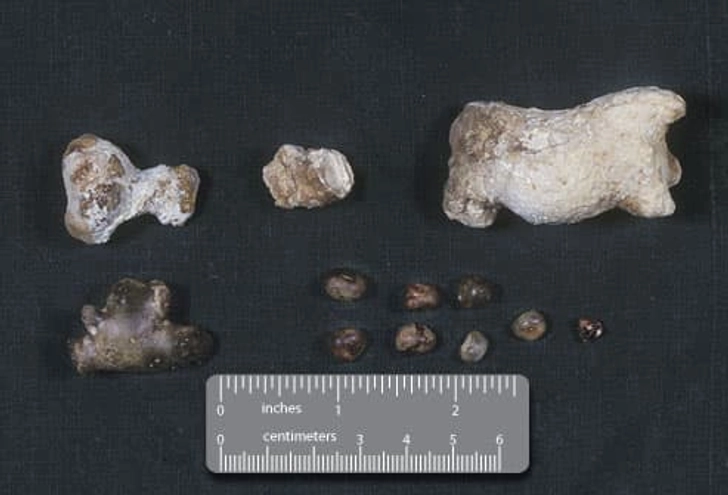 Kidney Stone Analysis Kidney Stone Analysis