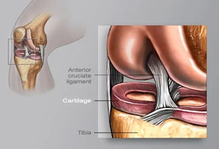 Replacing a Bad Knee