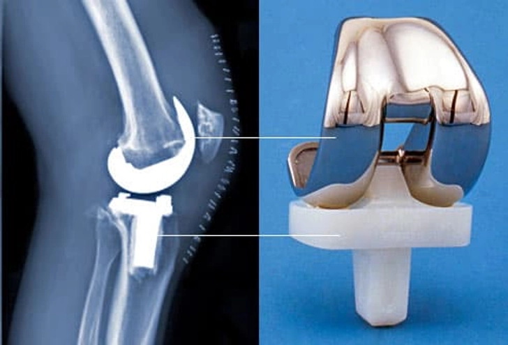 What Happens During Surgery?