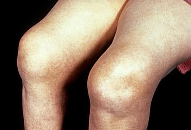 Rheumatoid Arthritis