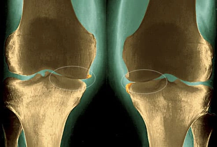 Osteoarthritis of the Knee Osteoarthritis of the Knee