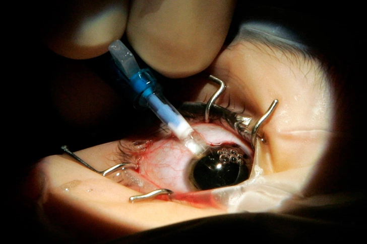Implantable Lenses Implantable Lenses