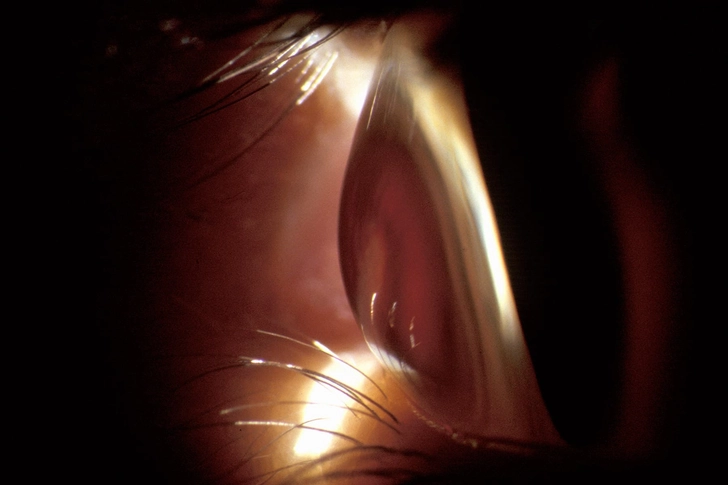 Cautions for Vision Surgery Cautions for Vision Surgery