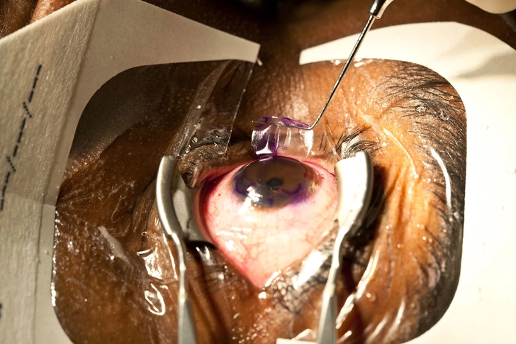 How LASIK Works
