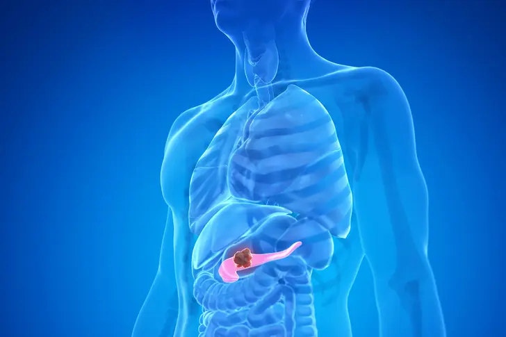 How Pancreatic Cancer Affects Your Body How Pancreatic Cancer Affects Your Body