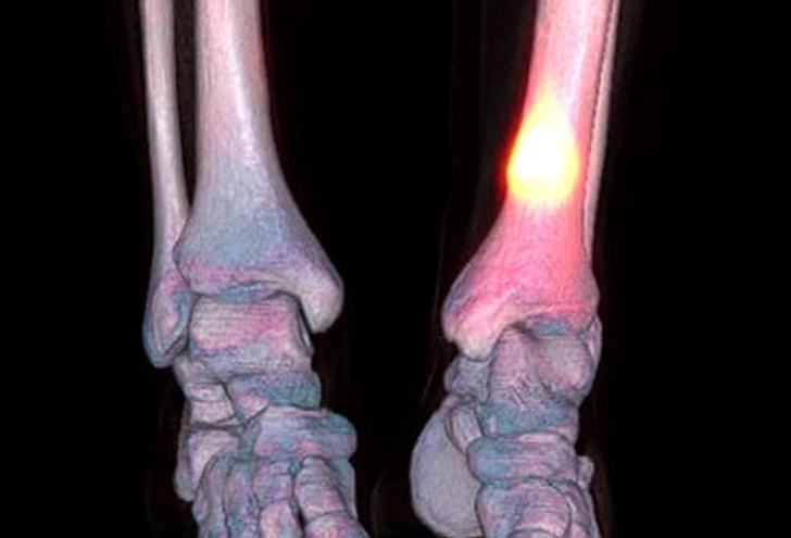 Stress Fracture