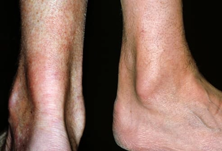 Tendinitis