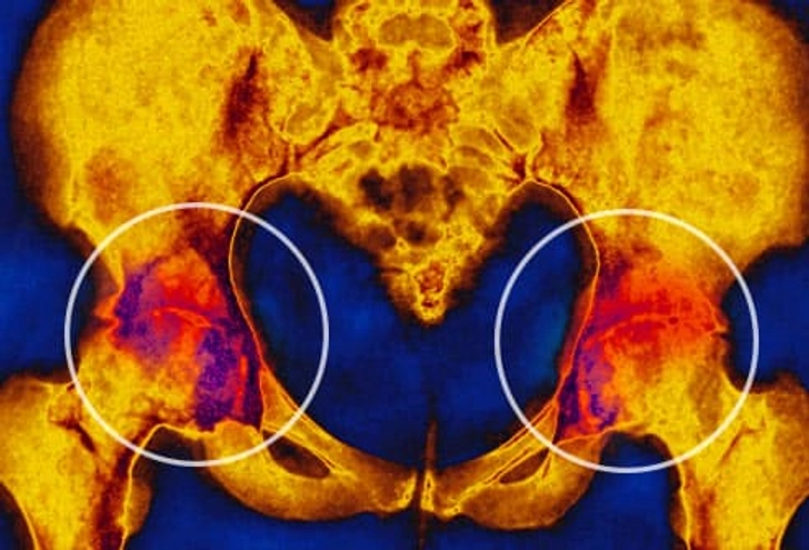 Arthritis