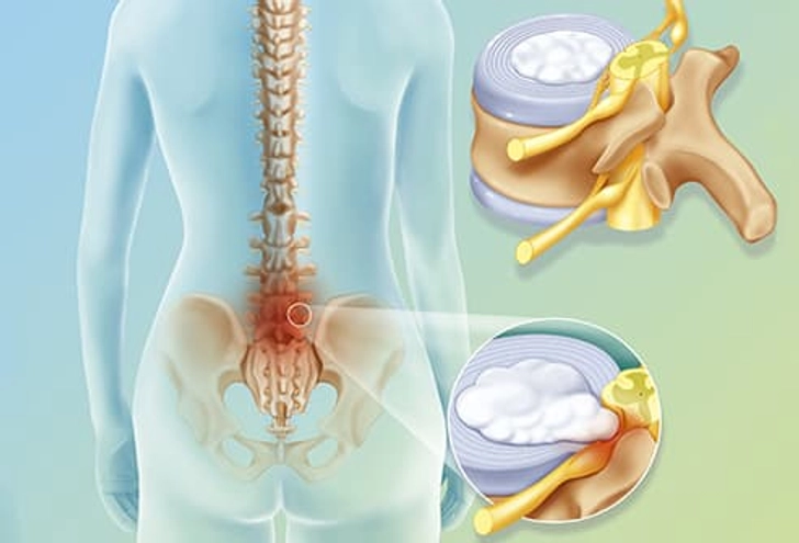 Sciatica