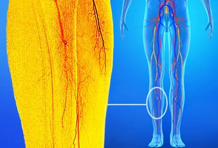 Peripheral Artery Disease (PAD)
