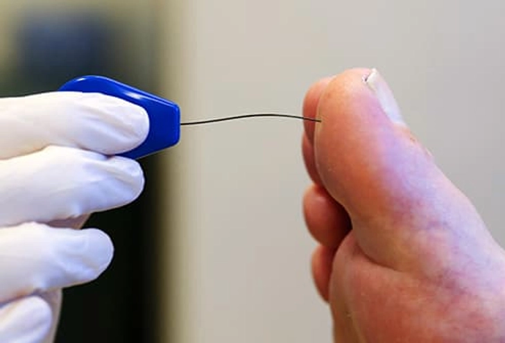 Peripheral Neuropathy