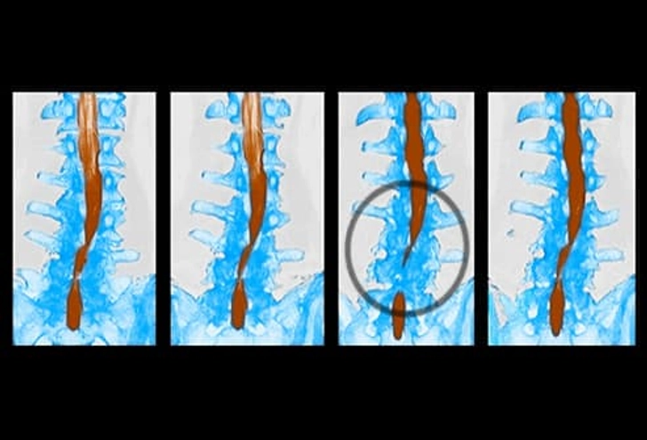 Spinal Stenosis