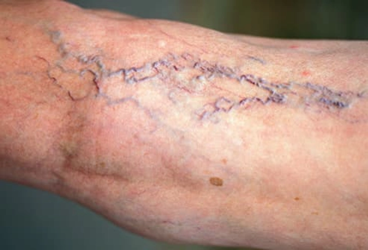 Varicose Veins
