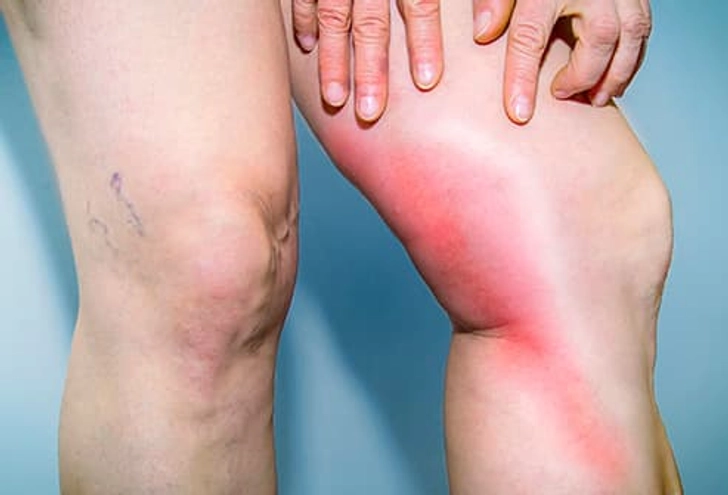 Deep Vein Thrombosis (DVT)