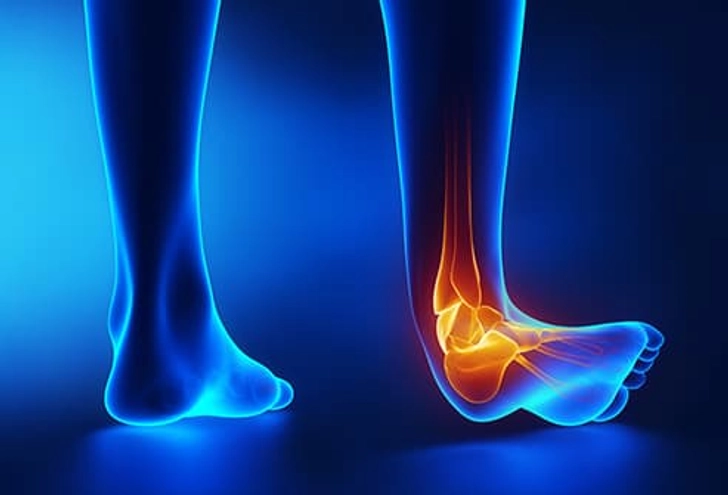 Sprain