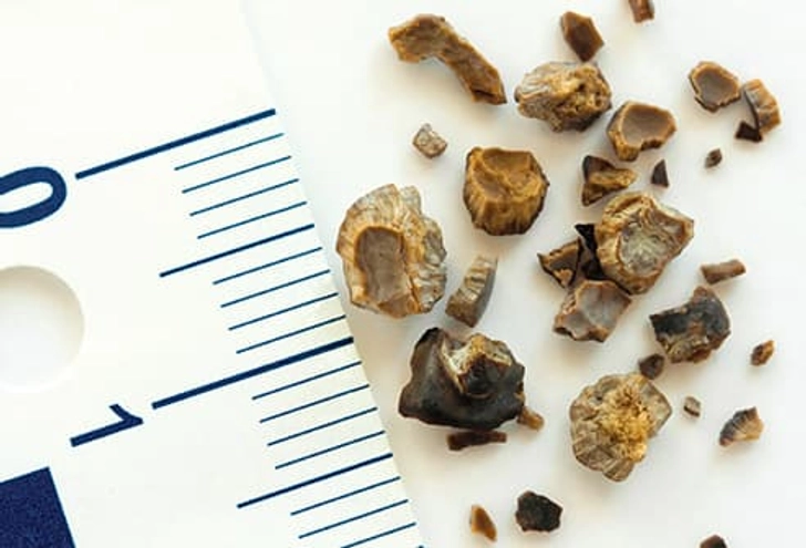 Prevent Kidney Stones