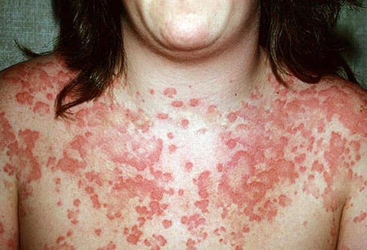 Anaphylaxis Warning Signs