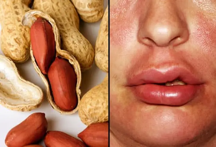 Peanuts Can Be Dangerous