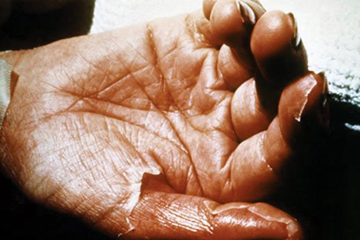 Toxic Shock Syndrome