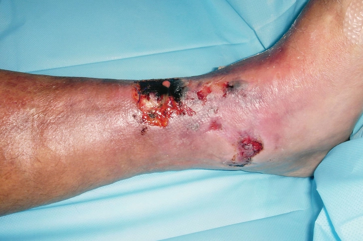 Necrotizing Fasciitis