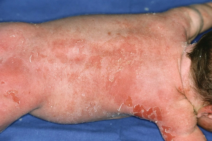 Staphylococcal Scalded Skin Syndrome