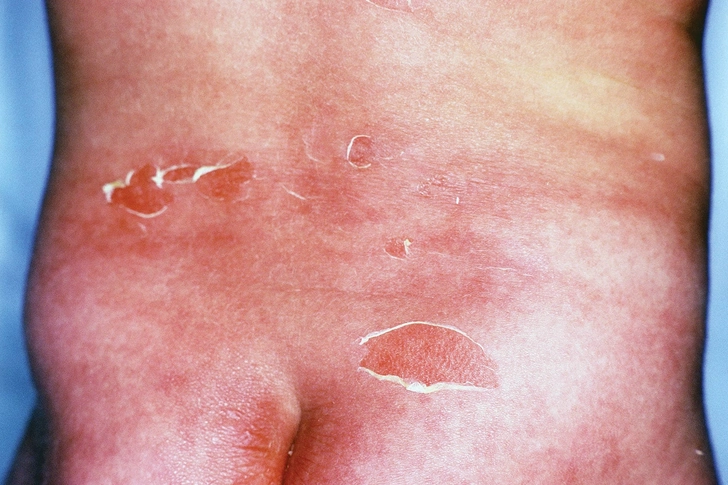 Toxic Epidermal Necrolysis