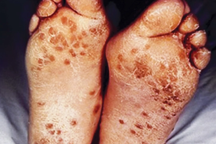Meningococcal Meningitis