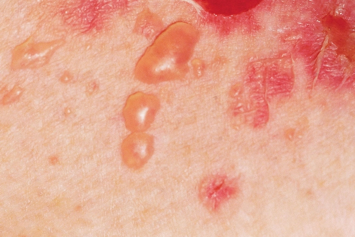 Pemphigus Vulgaris