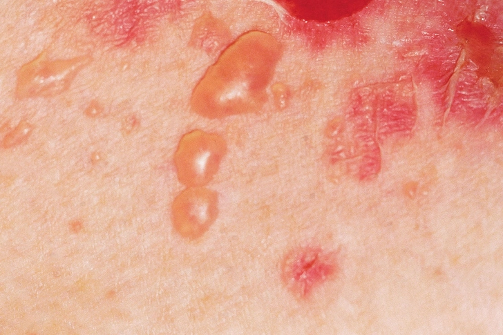 Pemphigus Vulgaris Pemphigus Vulgaris