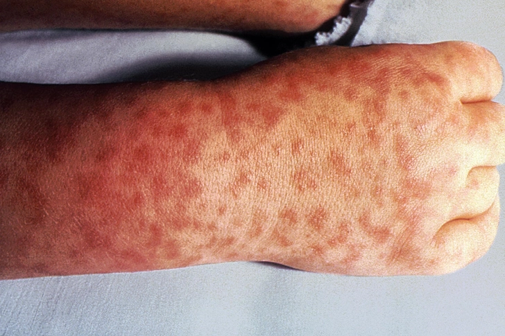 Rocky Mountain Spotted Fever