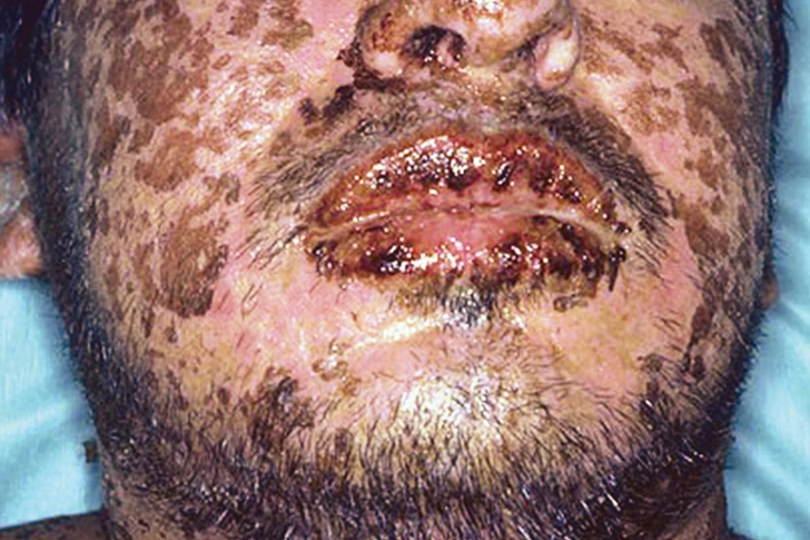 Stevens-Johnson Syndrome