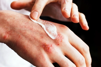 Care for Cracks in Skin