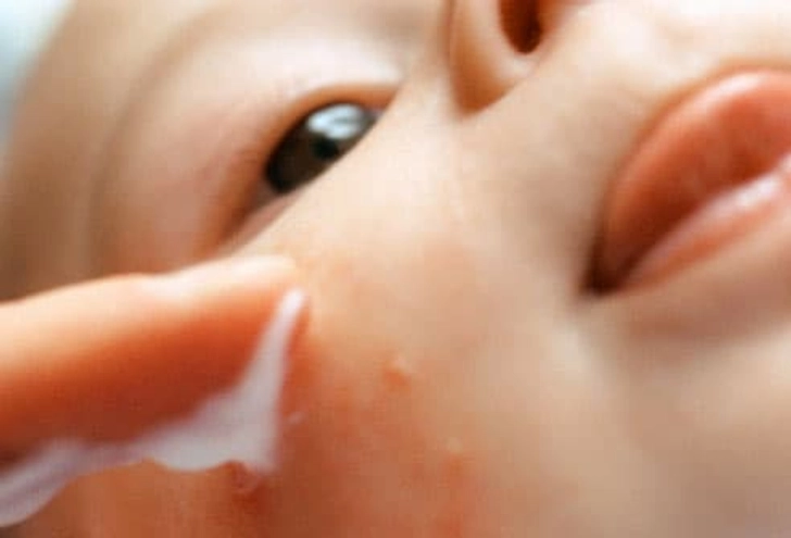 4. Rashes