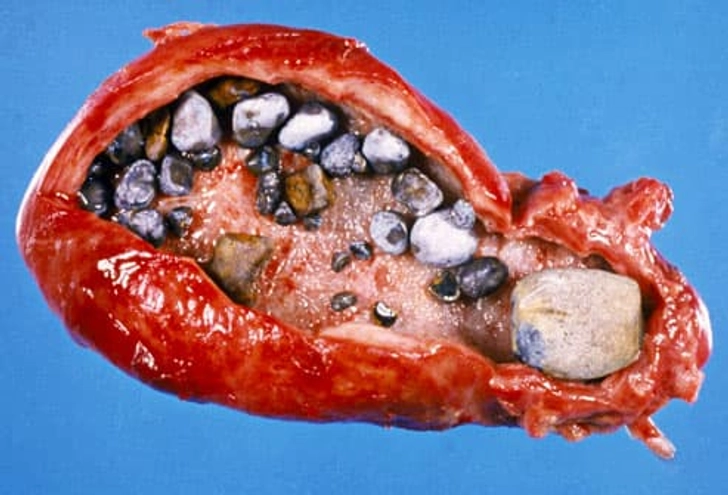 Gallstones Gallstones