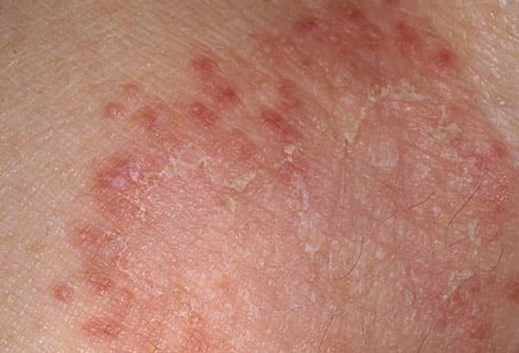 Ringworm