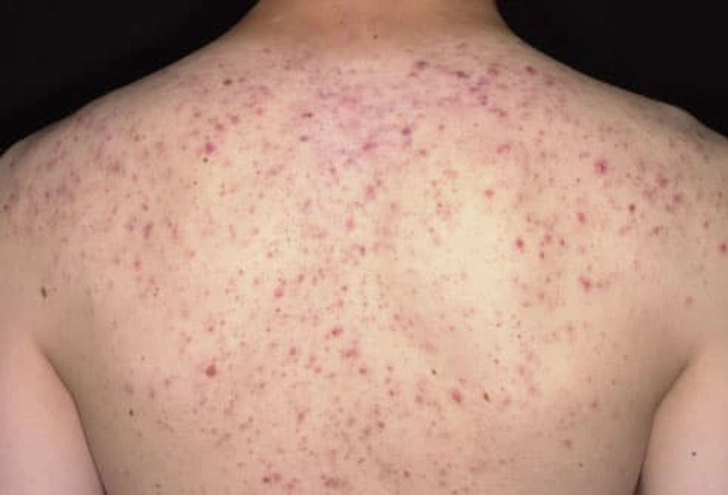 Back Acne