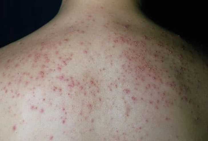 Heat Rash