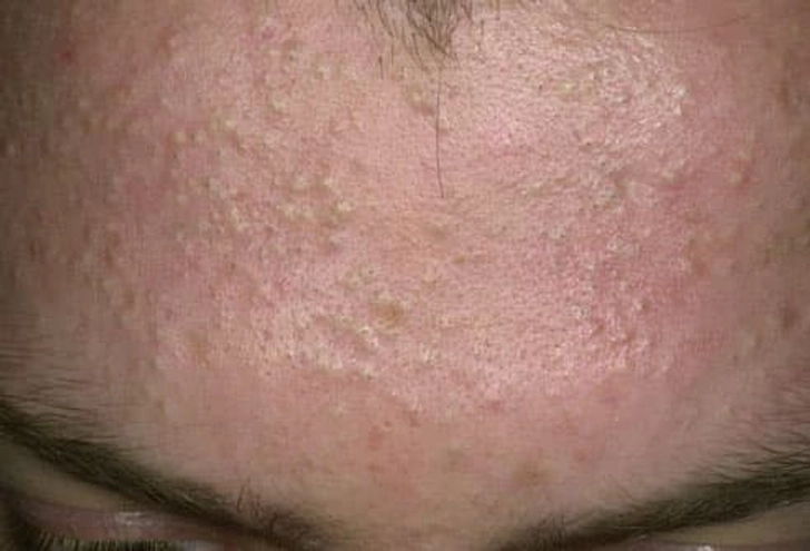 Helmet Acne