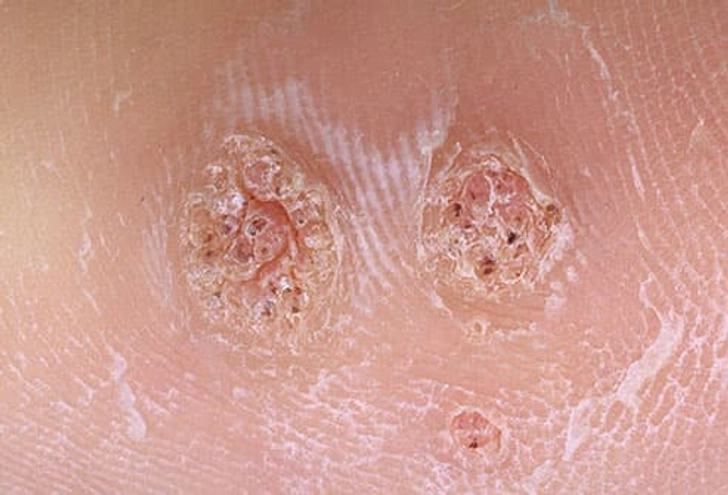 Plantar Warts