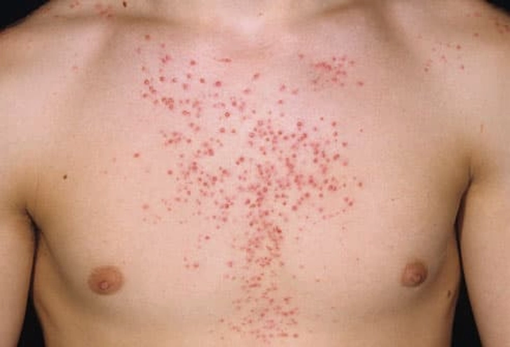 Steroid Abuse