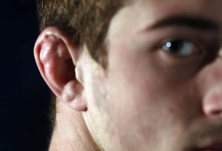 Cauliflower Ear Cauliflower Ear
